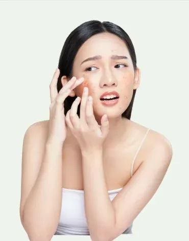暗瘡中醫治療：年輕女士以手觸摸面部暗瘡
