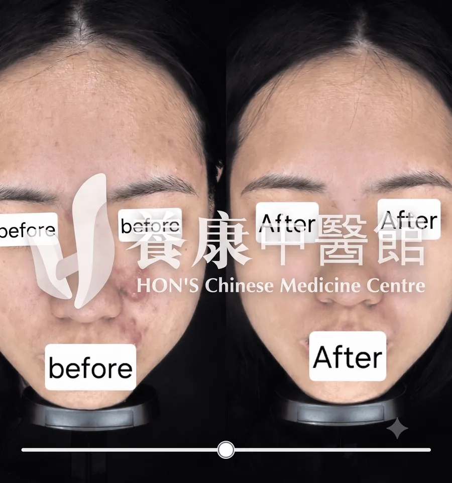 女性暗瘡患者治療前後對比
