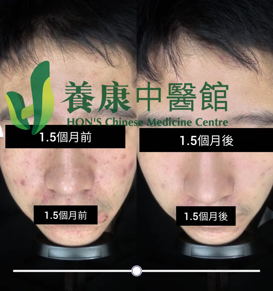 男性暗瘡患者治療 1.5 個月前後對比