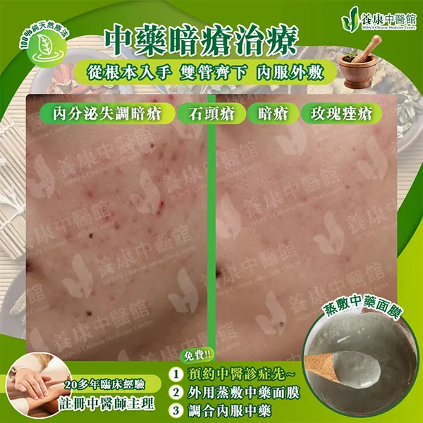 中藥暗瘡治療真實個案 1：治療前後對比