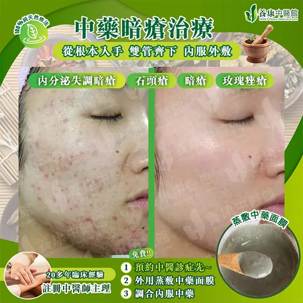 中藥暗瘡治療真實個案 2：治療前後對比