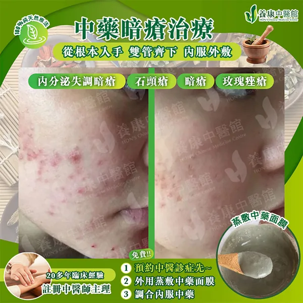 中藥暗瘡治療真實個案 3：治療前後對比