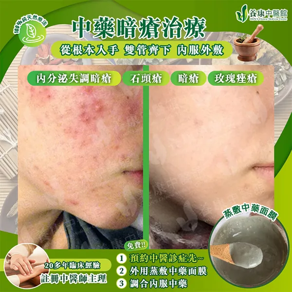 中藥暗瘡治療真實個案 4：治療前後對比