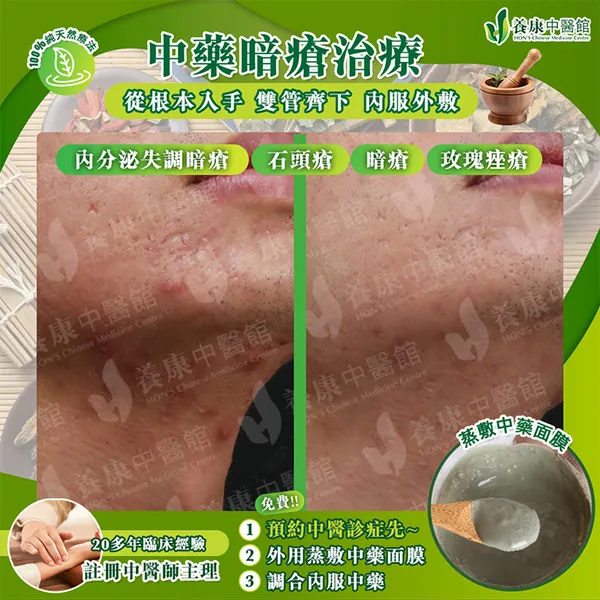 中藥暗瘡治療真實個案 5：治療前後對比
