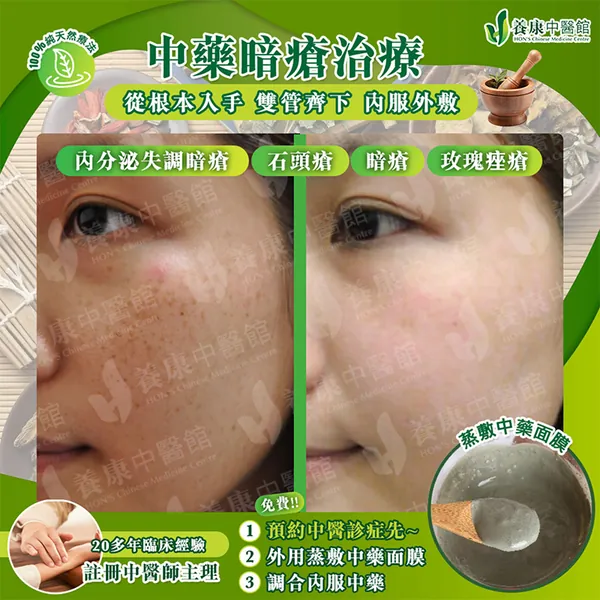 中藥暗瘡治療真實個案 6：治療前後對比