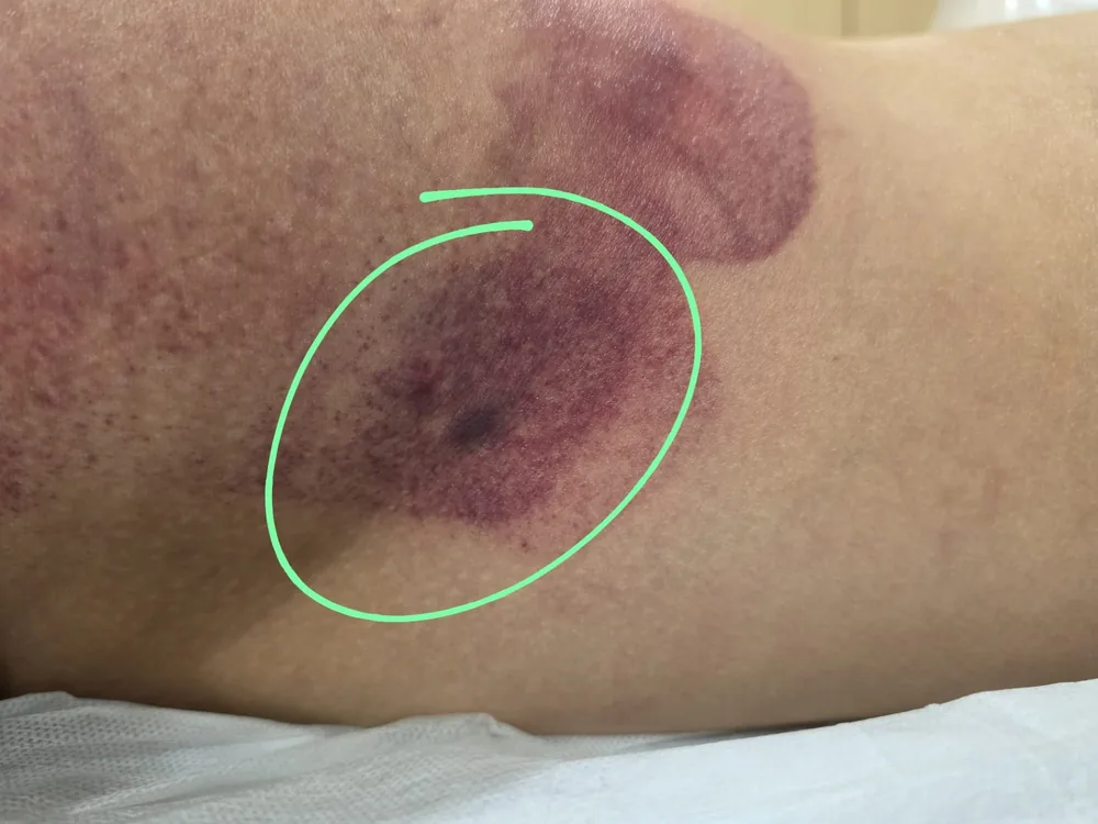傳統刮痧後手臂留下的大片紫色瘀痕(綠色圈示)