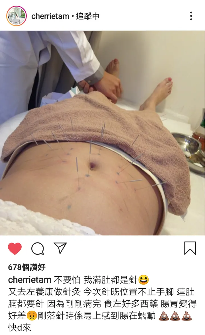 Cherrietam 不要怕 我滿肚都是針 又去左養康做針灸，今次針既位置不止手腳 連肚腩都要針 因為剛剛病完 食左好多西藥 腸胃變得好差 剛落針時係馬上感到腸在蠕動 快D來